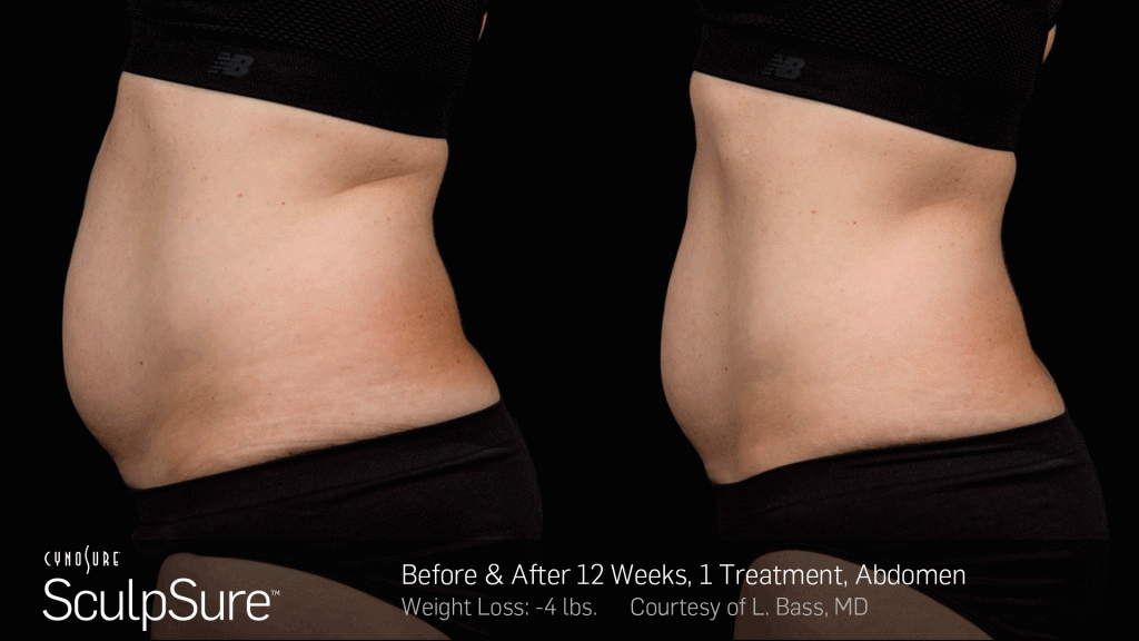 Before and after SculpSure photos in Tarzana